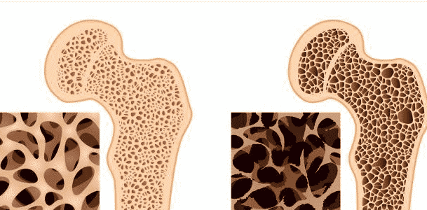 مرض هشاشة العظام - وطرق الحفاظ على عظامك